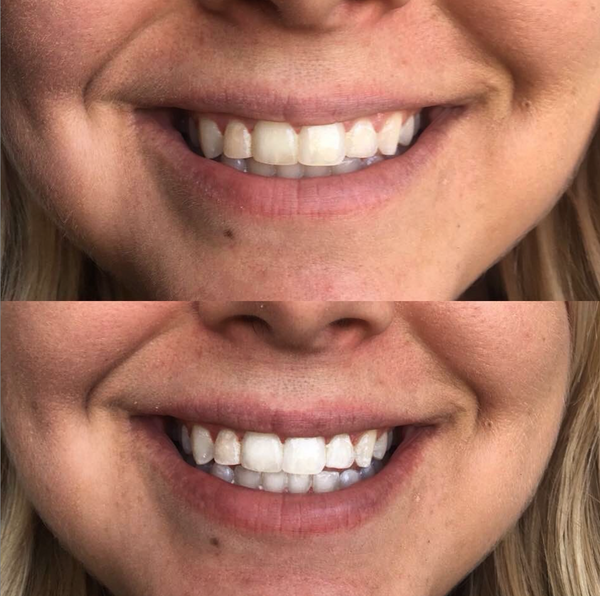 19858 LED Dual Whitening System